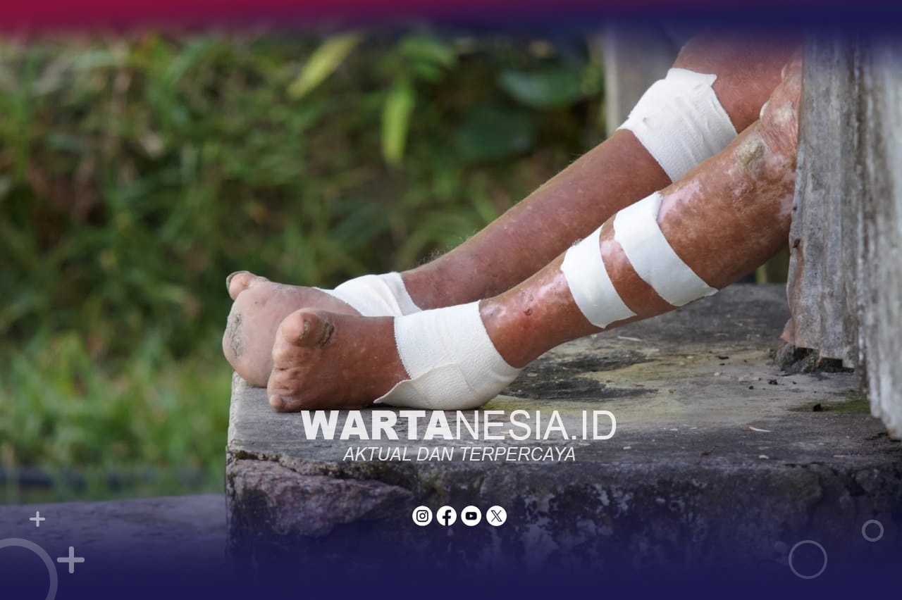 Ilustrasi kusta (canva.com)